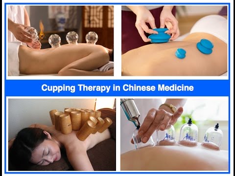 Cupping Therapy in Chinese medicine