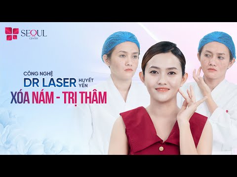 Tạm Biệt Nám Lâu Năm Nhờ Công Nghệ Dr Laser Huyết Yến