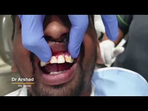 A patient undergoes Upper teeth extraction at the Dental specialist in coimbatore
