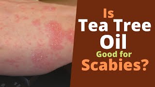 Tea Tree Oil for Scabies [Does It Kill Scabies?]