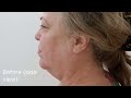 Deep Plane Facelift Watch Ann In Bangkok 21 Days Post Operation