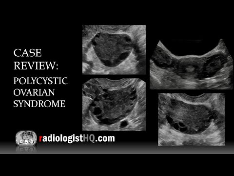 Ultrasound of Polycystic Ovarian Syndrome