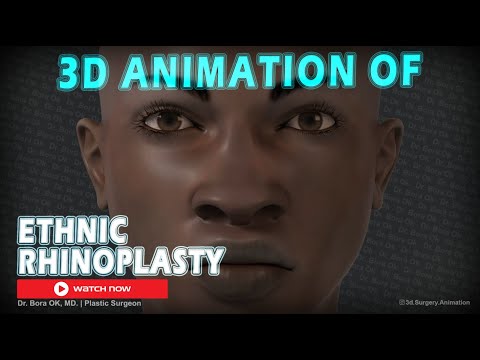 Dr. Bora Ok, MD. - 3D Animation Of Ethnic Rhinoplasty Surgery