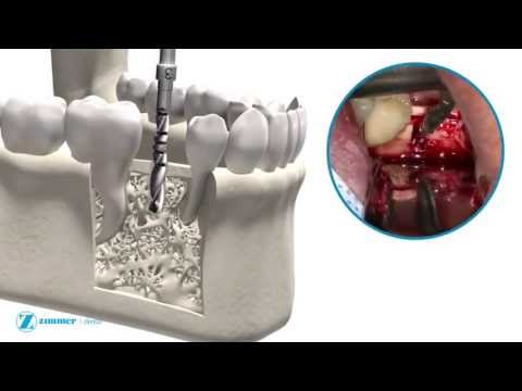 Zimmer Trabecular Metal Dental Implant - MDEA 2013 Silver Winner