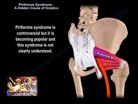 Piriformis Syndrome A Hidden Cause of Sciatica - piriformis syndrome causes, diagnosis and treatment