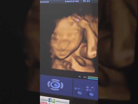 2D/3D ULTRASOUND AT 24 WEEKS and 2 DAYS PREGNANCY