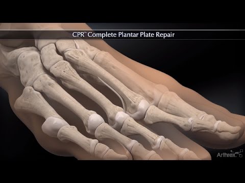 Cpt Code Plantar Plate Repair