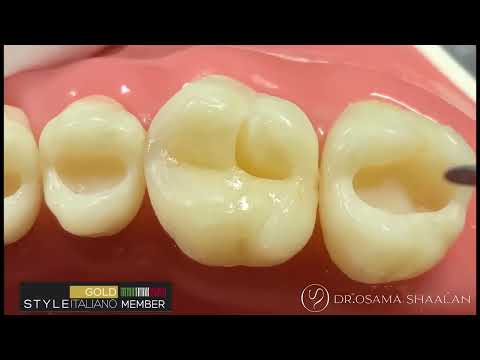 Lm arte Replica posterior by Styleitaliano - Replica of upper 6