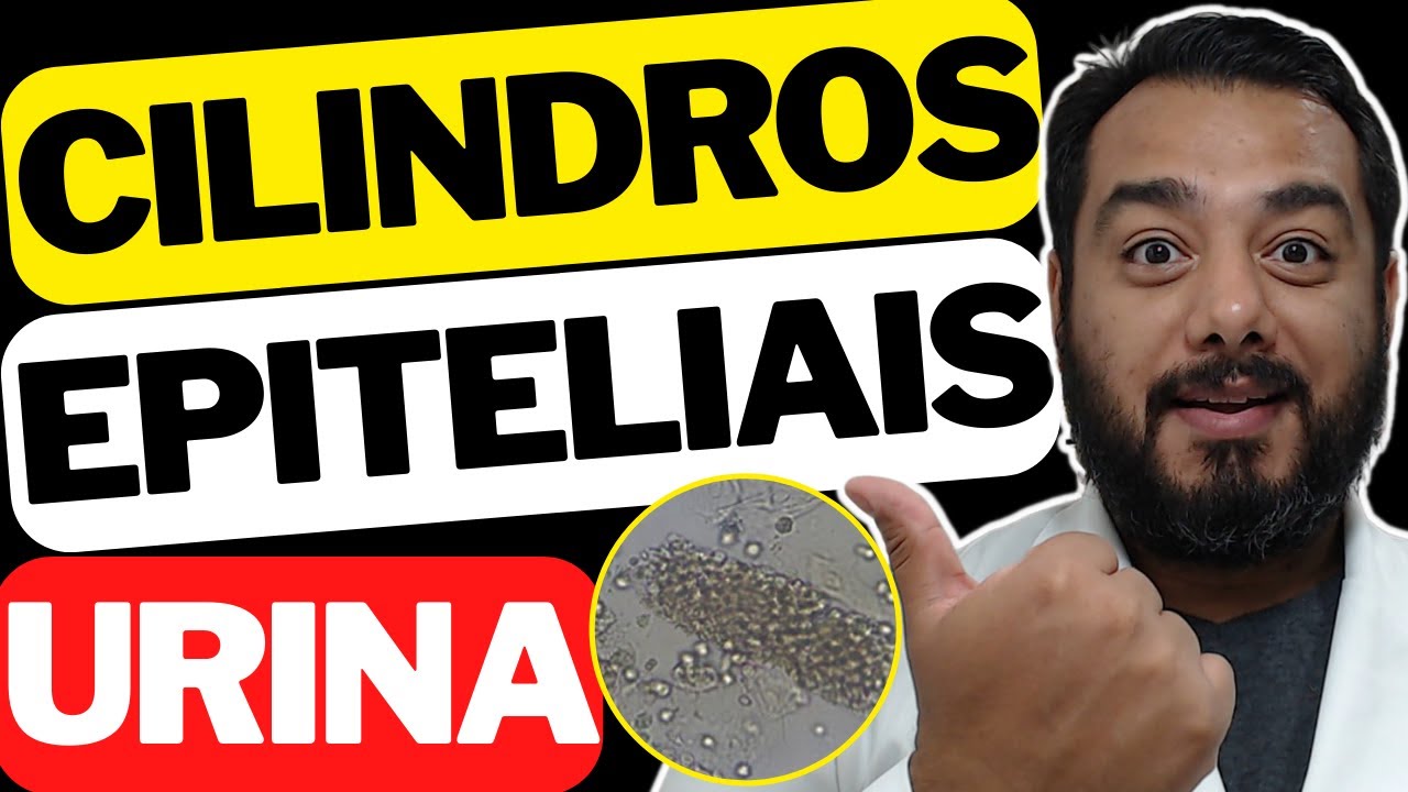 Cilindros epiteliais na urina: quais as causas Sedimentoscopia | Exame de urina tipo 1 | EAS