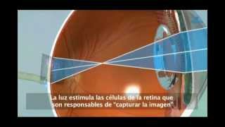 Desprendimiento de Retina