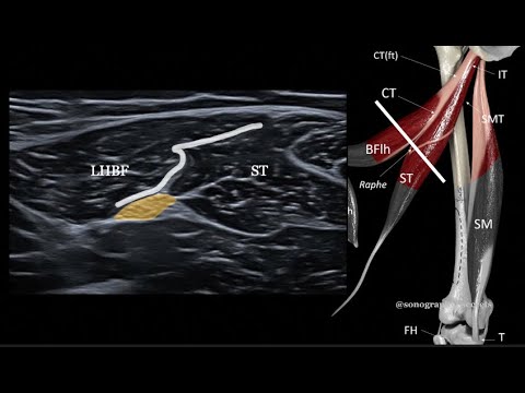 Ultrasound of the proximal hamstring