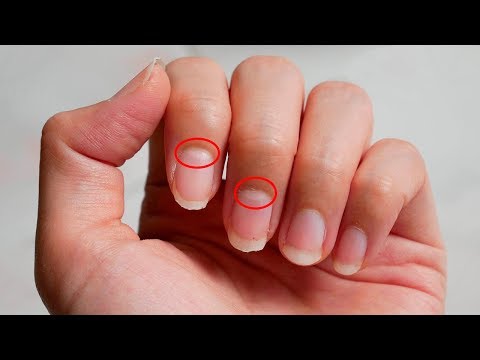 The Moons on Your Nails Reveal This About Your Health