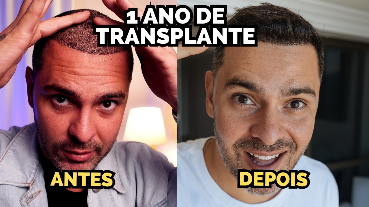 1 ANO DEPOIS DO MEU TRANSPLANTE CAPILAR  - PRINCIPAIS DÚVIDAS
