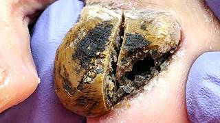 Black And Hard Onychomycosis, Completely Clear The Black Mud【Xue Yidao】