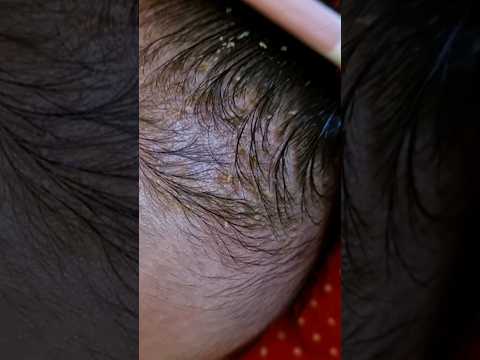 Baby Cradle Cap cleaning #baby #cradle #cradlecap #newborn