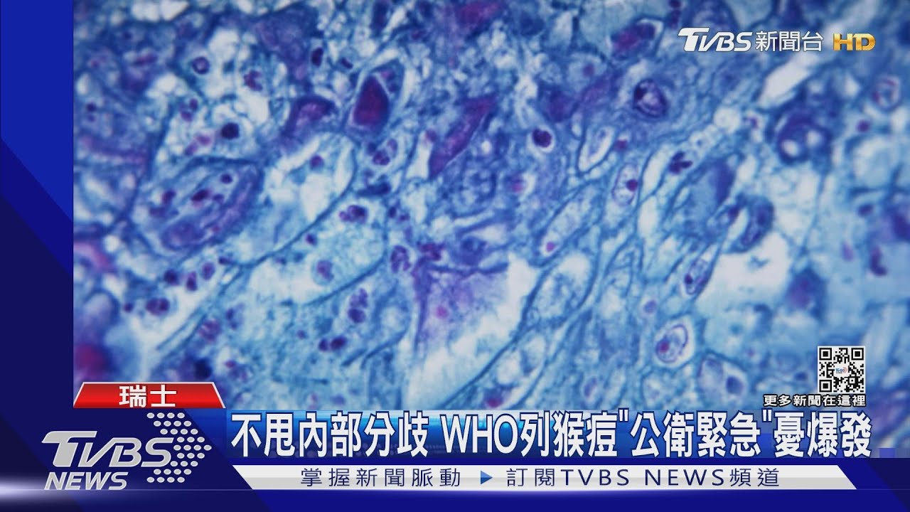 猴痘列公衛緊急事件 譚德塞:有全球傳播風險