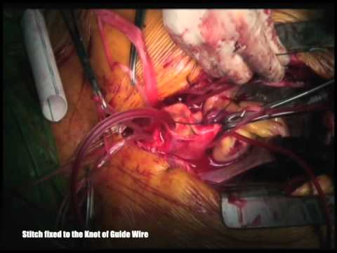 Elephant Trunk in Aortic Dissection Surgery with Guide Wire