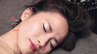 CALISTA 美容鍼灸体験レポート