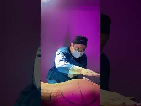 Melhorando o #bumbum sem silicone🍑 #lipoenxertiaglutea