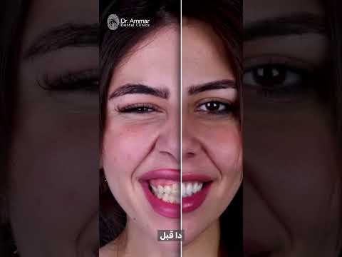 مصر – قص لثة + فنيرز