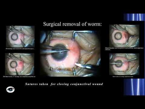 Ascaris és pinworm tünetei
