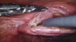 Versa Lifter Needle - Robotic Assisted Sacrocolpopexy