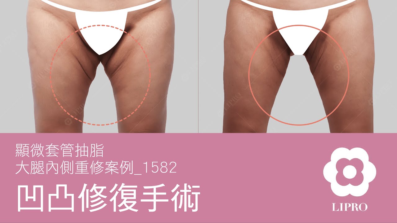 凹凸修復手術｜顯微套管抽脂｜大腿內四角重修案例_1582