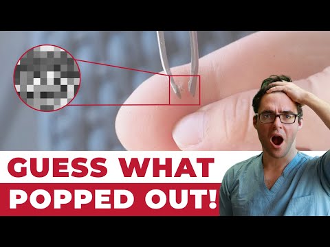 HUGE Foot PIMPLE filled with dead FAT Crystals