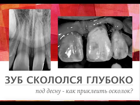 Коронково-корневой перелом постоянного зуба