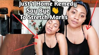 HOW TO GET RID OF STRETCH MARKS FOR GOOD! WITH JUST 1 REMEDY|HOME REMEDIES & TREATMENTS THAT WORK!