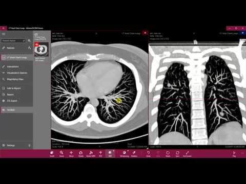 MIP and MinIP - Athena DICOM Viewer