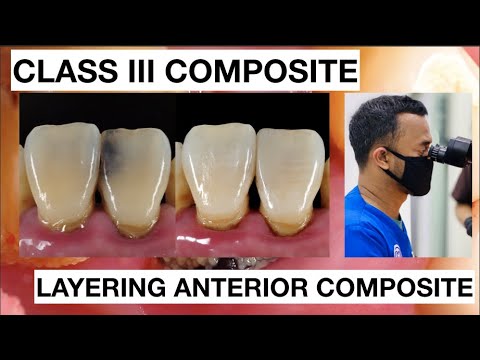 Step by Step Class III Composite Restoration