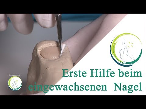 Wie gribok der Beine furazilinom zu behandeln Die Tabletten für die Behandlung gribka der Nägel die Rezensionen