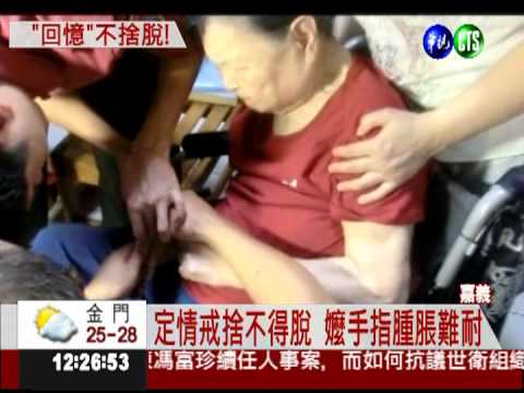 定情戒戴60年 九旬嬤手指腫1倍
