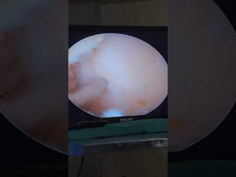 KNEE MENISCUS REPAIR WITH MICROFRACTURE - DR DEEPAK KOLI