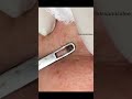 DPOW Wow Shorts Youtubepartner Drpimplepopper Popaholics Dpow