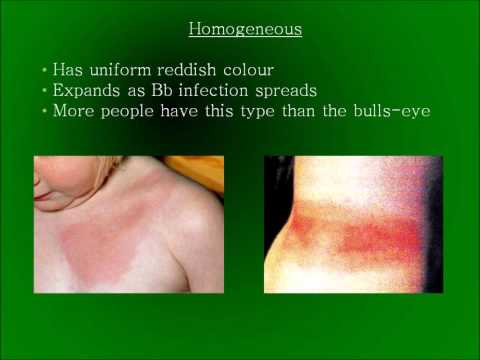 Tick-Borne Disease Survival Guide.wmv