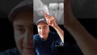 Estas muelas del juicio causan mucho daño (cordales peligrosas) #shorts