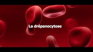 La drépanocytose au CHR de Liège : témoignages de patients (sous-titres NL)