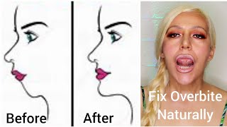 How To Fix an Overbite Naturally Without Surgery | Get Rid of Gorilla Mouth