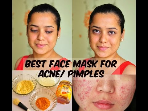 download lagu mp3 mp4 Besan For Pimples, download lagu Besan For Pimples gratis, unduh video klip Besan For Pimples