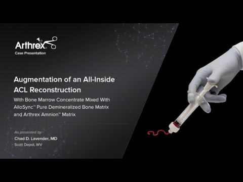 All-Inside ACL Reconstruction with AlloSync Pure - Arthrex