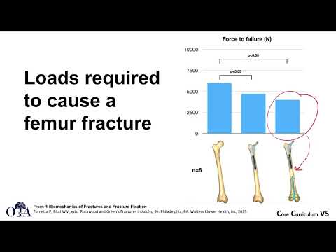 Biomechanics of fractures and fixation - 2 of 4
