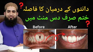 How to Close Gap Between Teeth, Composite Bonding & Veneers in Hindi / Urdu