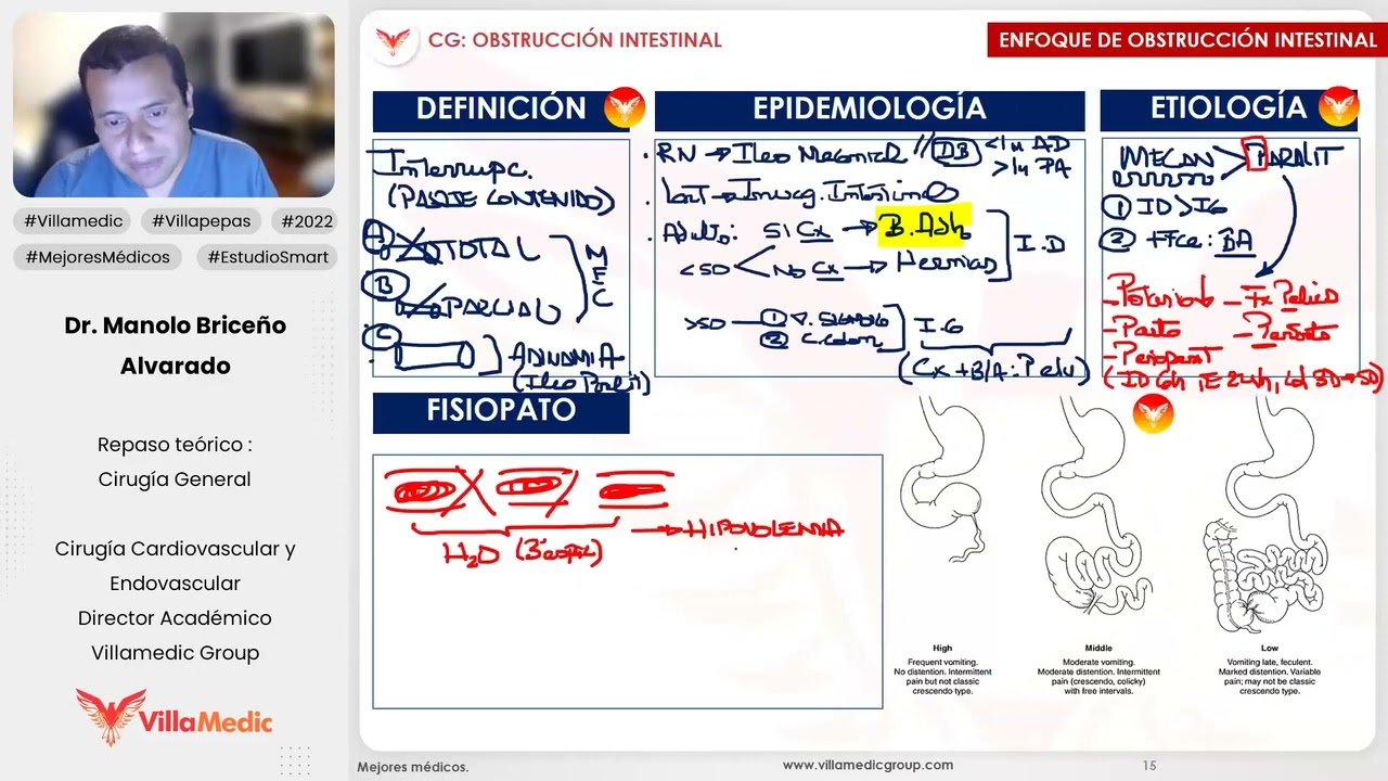 OBSTRUCCIÓN INTESTINAL PARTE 1 - CIRUGÍA GENERAL - VILLAMEDIC