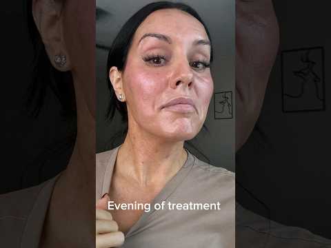 Morpheus results 🫣 #morpheus #morpheus8 #antiaging #skincareover40 #dayinmylife #beforeandafter