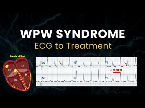 Wolff-Parkinson-White (WPW) Syndrome | ECGs to Treatments