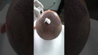 First Hair Wash After the Hair Transplant || Long Hair Center Istanbul.