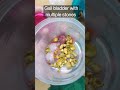 Gall Bladder With Multiple Stones Healthmedia