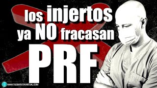 INJERTO de HUESO lo que NUNCA te DICEN!!!